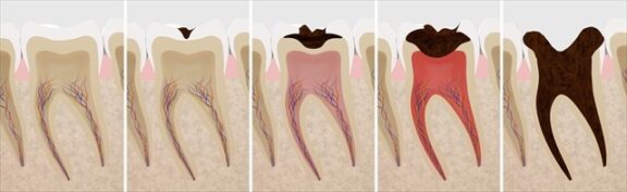 虫歯の進行段階と症状